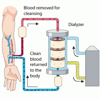 Understanding dialysis and how a dialyzer works